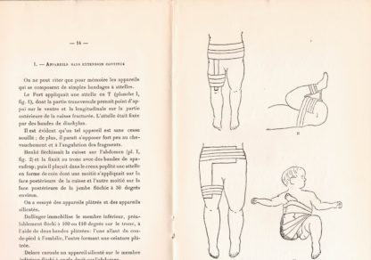 Traitement des fractures obstetricales du femur.